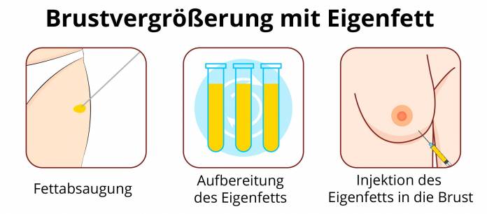 Brustvergrößerung mit Eigenfett